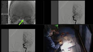 Mechanical Thrombectomy for Acute Stroke