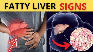 TOP 10 Signs Of Fatty Liver You Must Avoid: Causes,  Early symptoms, treatment.