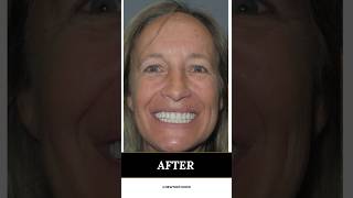 Jodi’s smile transformation with dental implants