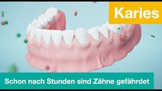 Karies - so schnell sind Zähne in Gefahr