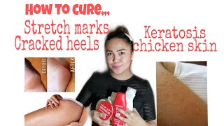 Cure for Cracked heels|Chicken Skin|Stretch Marks