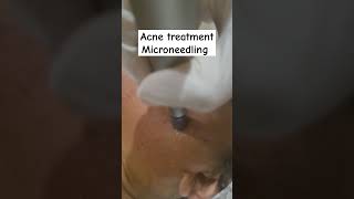 Skin needling treatment for acne #microneedling #acnetreatment #ytshorts #viralvideo #skincare