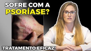 COMO ACABAR DE VEZ COM A PSORÍASE [REVELADO]