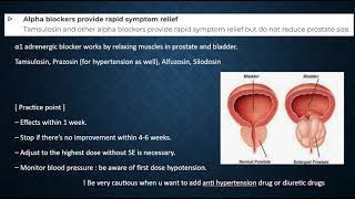 BPH, benign prostate hyperplasia, Roze pharm