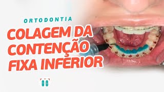 Dica de Ortodontia - Como descomplicar a Colagem da Contenção Fixa Inferior