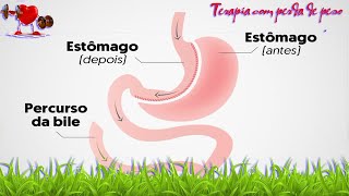 Saúde -   Cirurgia bariátrica: o que é, quem pode fazer, tipos e riscos