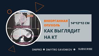 Внебрюшинная ретроковально расположенная опухоль I КТ I  Дмитрий Савенков I  Днепр