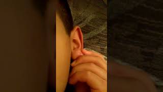 Oreja infectada por perforación 👂