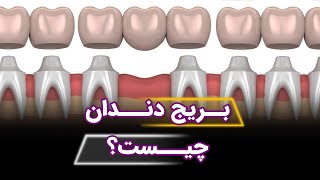 بریج دندان چیست؟❌