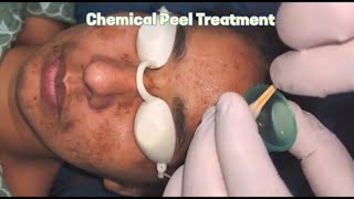 Chemical Peel: Step by step guide @DrArifMDDermatologist#chemicalpeel #acnetreatment #acneproneskin