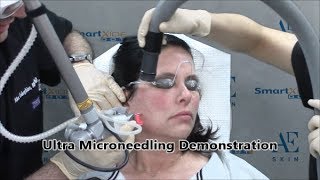 Ultra Microneedling Demonstration 16 - A E Skin - Encino, CA - 818-835-1833