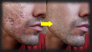 How To Stop Acne For Men - 4 Tips For Clear Skin - Fix Pimples, Breakouts & Blackheads