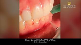 Gingivectomy with LiteTouch™ Er:YAG laser