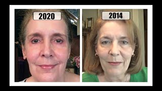 Changes in My Skincare + 6 Years Using Retin A~Comparison Footage