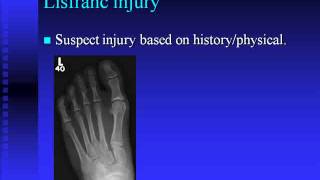 Lisfranc Injuries