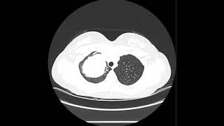 Robotic Thoracic Surgery For a Large Pulmonary Metastasis with Bronchial Involvement