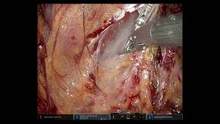 SAFE (Saline-Assisted Fascial Exposure) for Nerve-Sparing during RARP