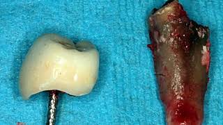 Same day extraction with implant placement