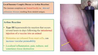 Type III – Hypersensitivity Reactions Part 3