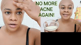 NO MORE ACNE EVER AGE - USE THIS ACNE VANISHING PASTE