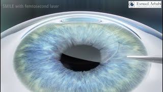 SMILE  (ReLEx SMILE) Laser Eye Surgery: High quality animation video