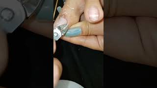 How to remove toenail ingrown #shorts