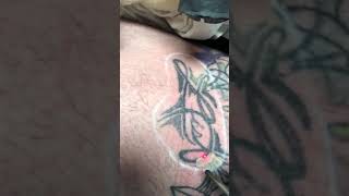 Laser tattoo removal on upper thigh, removing name tattoo