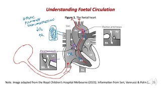 Pre-ductal pulse oximetry - why does the probe always go on a newborn's right hand?