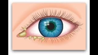 EYE BOOGERS KIA HN . . . . .  آنکھوں کا ڈسچارج وجوہات اور علاج کیا کریں  . . . . #healthy #viralshor