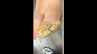 Removing THICK, CRUSTY CALLUSES! #shorts #shortsvideo #shortsviral