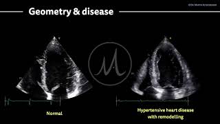 〖Echocardiography〗 Hypertensive heart disease & the left ventricle