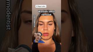 WISDOM TEETH REMOVAL WENT WRONG? Or #wisdomteethremoval #wisdomtoothextraction #wisdomteeth