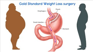 Gold Standard Weight Loss surgery (Roux-en-Y gastric bypass) RYGB by Dr Vikrant Sharma, Lap Surgeon