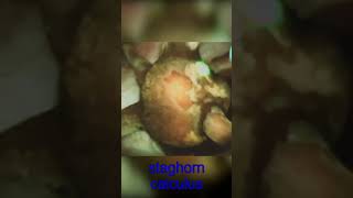 Staghorn Calculus | Kidney Stone | Huge Stone with horns in kidney