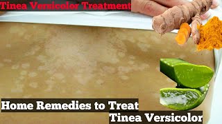 5 Effective Home Remedies for Treating Tinea Versicolor - Home Treatment of Tinea Versicolor