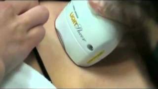 Laser Hair Removal, Intense Pulsed Light, Pacific Beach, (8