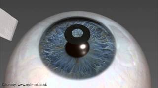 KAMRA Inlay Procedure Animation - Assil Eye Institute Los Angeles