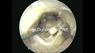 incus turban (TB dissection)-dr.shreekantha acharya