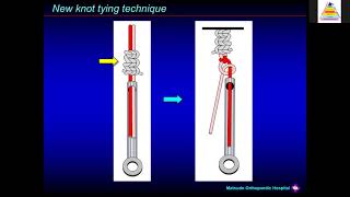 Trans Osseous Rotator Cuff Repair