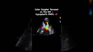 Color Doppler in a hypoplastic posterior mitral valve leaflet 💝