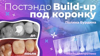 Постэндо l Build-up под коронку