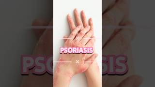 Psoriasis #shortsfeed #doctor  #psoriasis