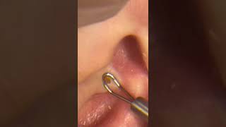 Blackheads In Ear