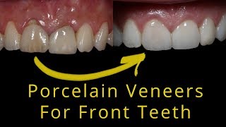 Natural looking Porcelain veneers for broken teeth