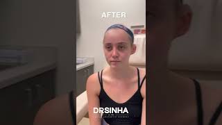 Beautiful Rhinoplasty Before and After Revealed | Dr. Sinha