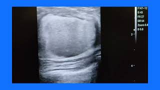 Large galactocele breast, ultrasound and color Doppler imaging, sonography, and management