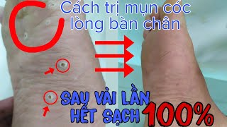 cách trị mụn cóc dưới lòng bàn chân đơn giản