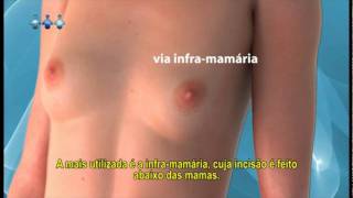 Prótese de Mama (Implante de Silicone nos seios)