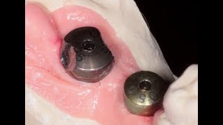 Healing Abutment is Stuck!