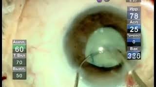 White cataract phacoemulsification . Факоэмульсификация перезрелой катаракты, техника борозды